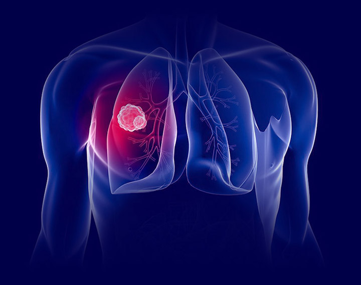 H2 Therapy Lung Cancer Tumor
