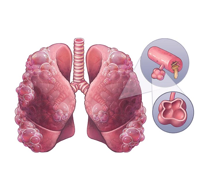Lung » Asthma, COPD